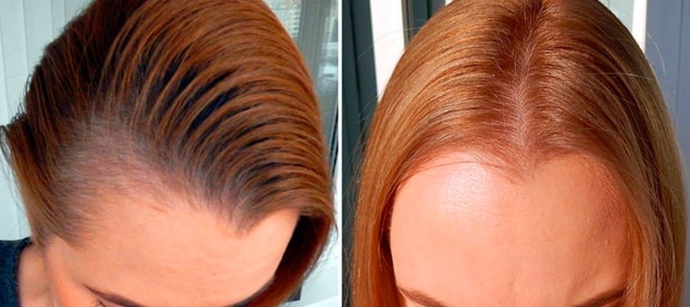 эффект дарсонвализации для волос, дарсонваль для волос, фото до и после дарсонвализации волос, дарсонваль при облысении