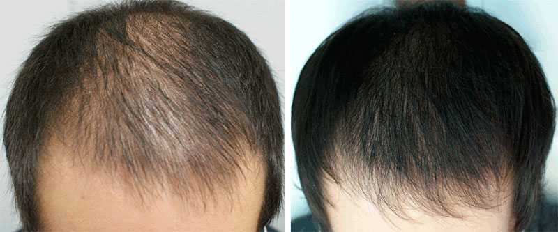 эффект дарсонвализации для волос, дарсонваль для волос, фото до и после дарсонвализации волос, дарсонваль при облысении